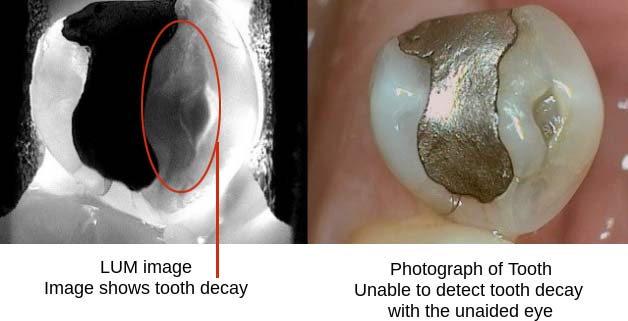 lum image tooth ecologic dentistry
