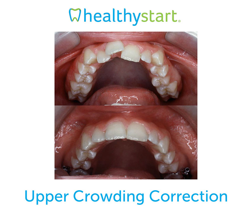 healthy start crowding correction before/after