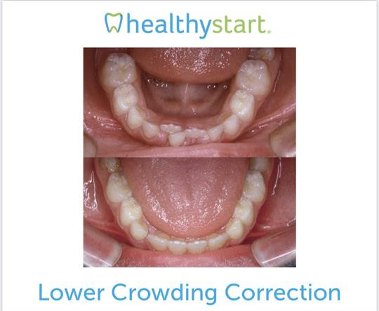 lower crowding correction