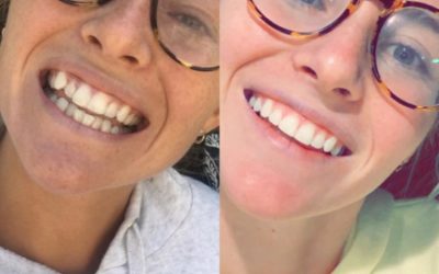 Introducing: CandidPro Clear Aligners
