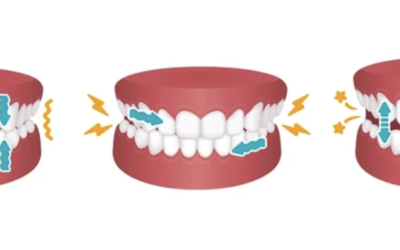 Teeth Grinding & Bruxism: Understanding and Finding Relief