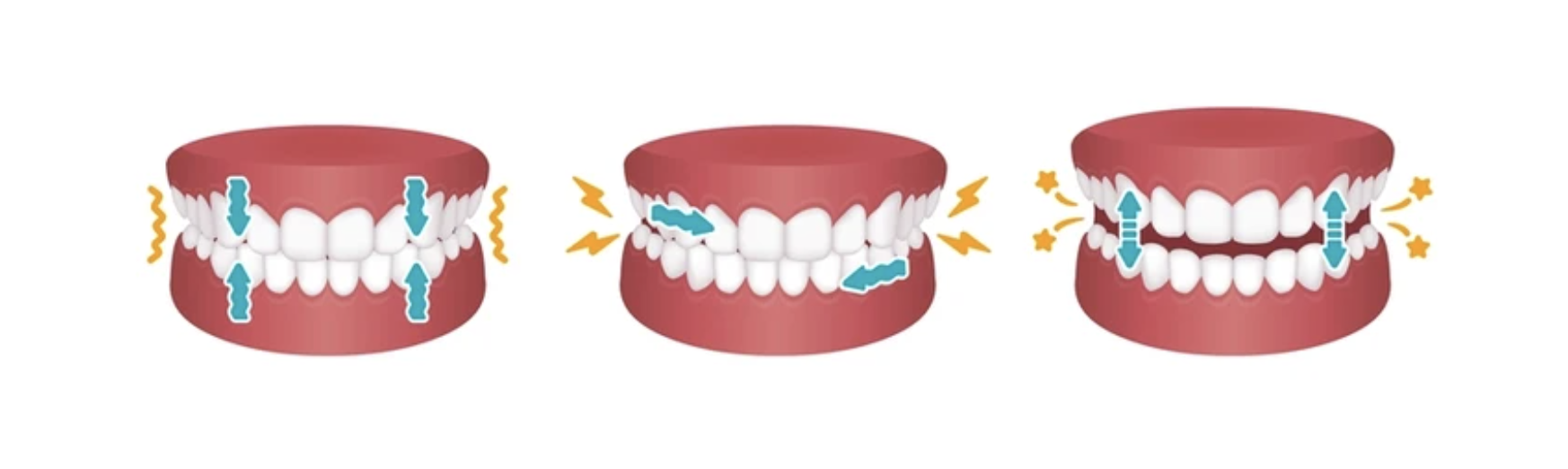 Teeth Grinding & Bruxism