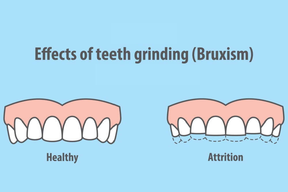 Teeth Grinding & Bruxism