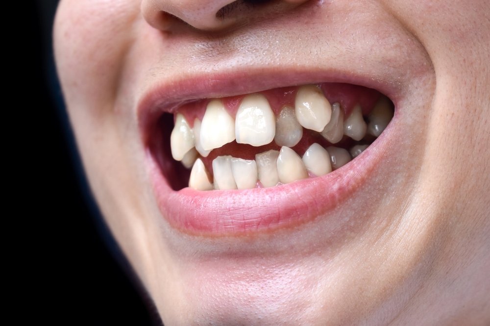 Crooked Teeth And Your Airway More Than Just A Cosmetic Concern 