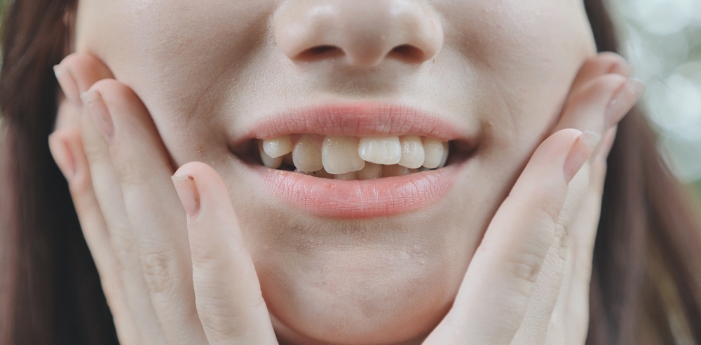 crowded teeth in bonney lake wa